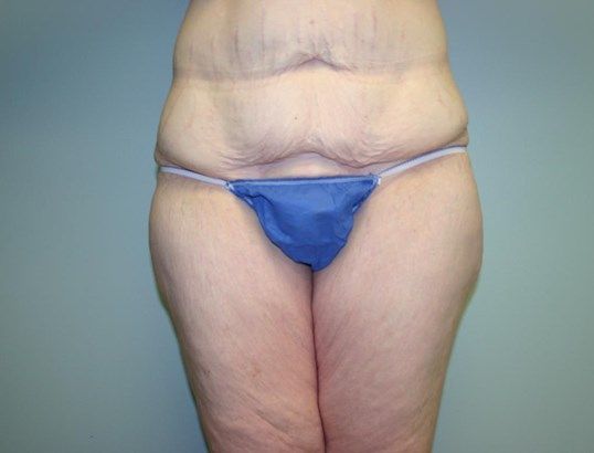 Tummy Tuck Before & After
