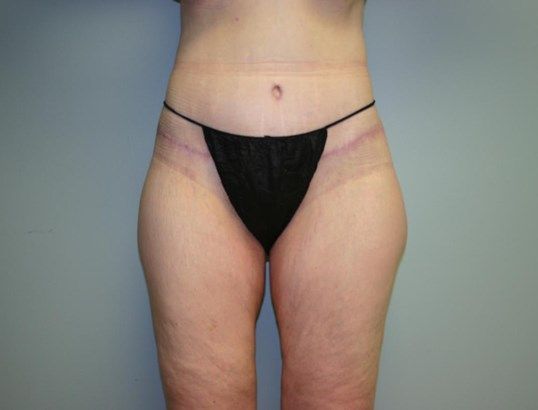 Tummy Tuck Before & After