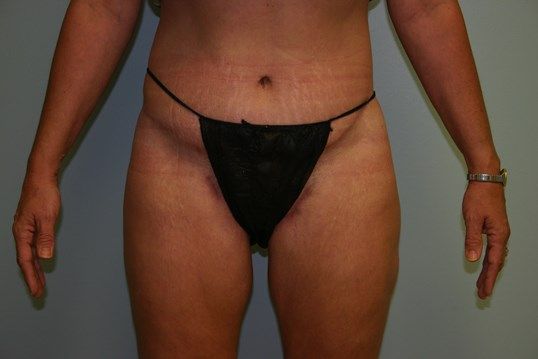 Tummy Tuck Before & After