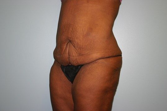 Tummy Tuck Before & After