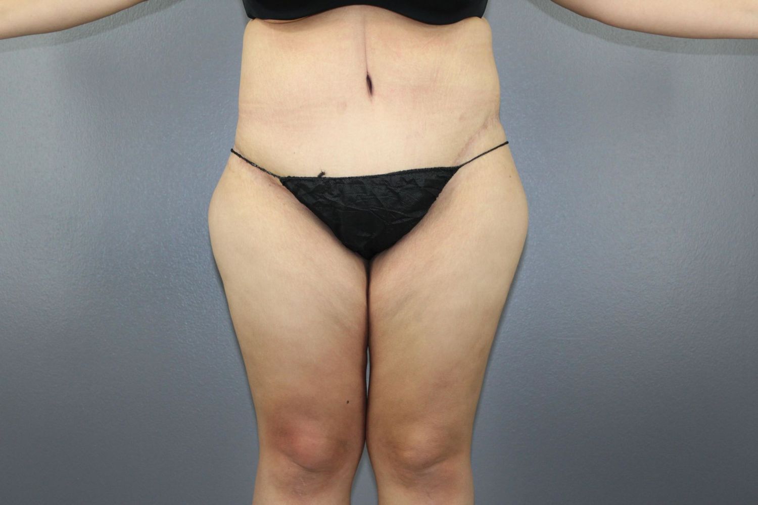 Tummy Tuck Before & After