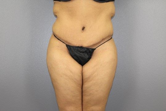 Tummy Tuck Before & After