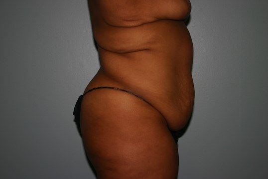 Tummy Tuck Before & After