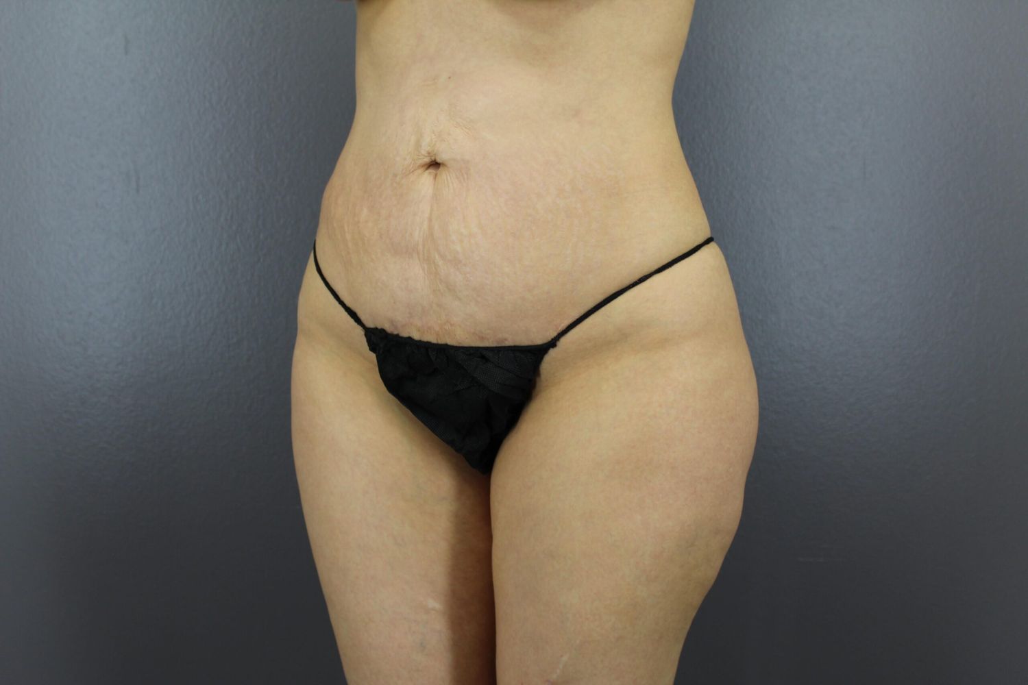 Body Contouring Before & After