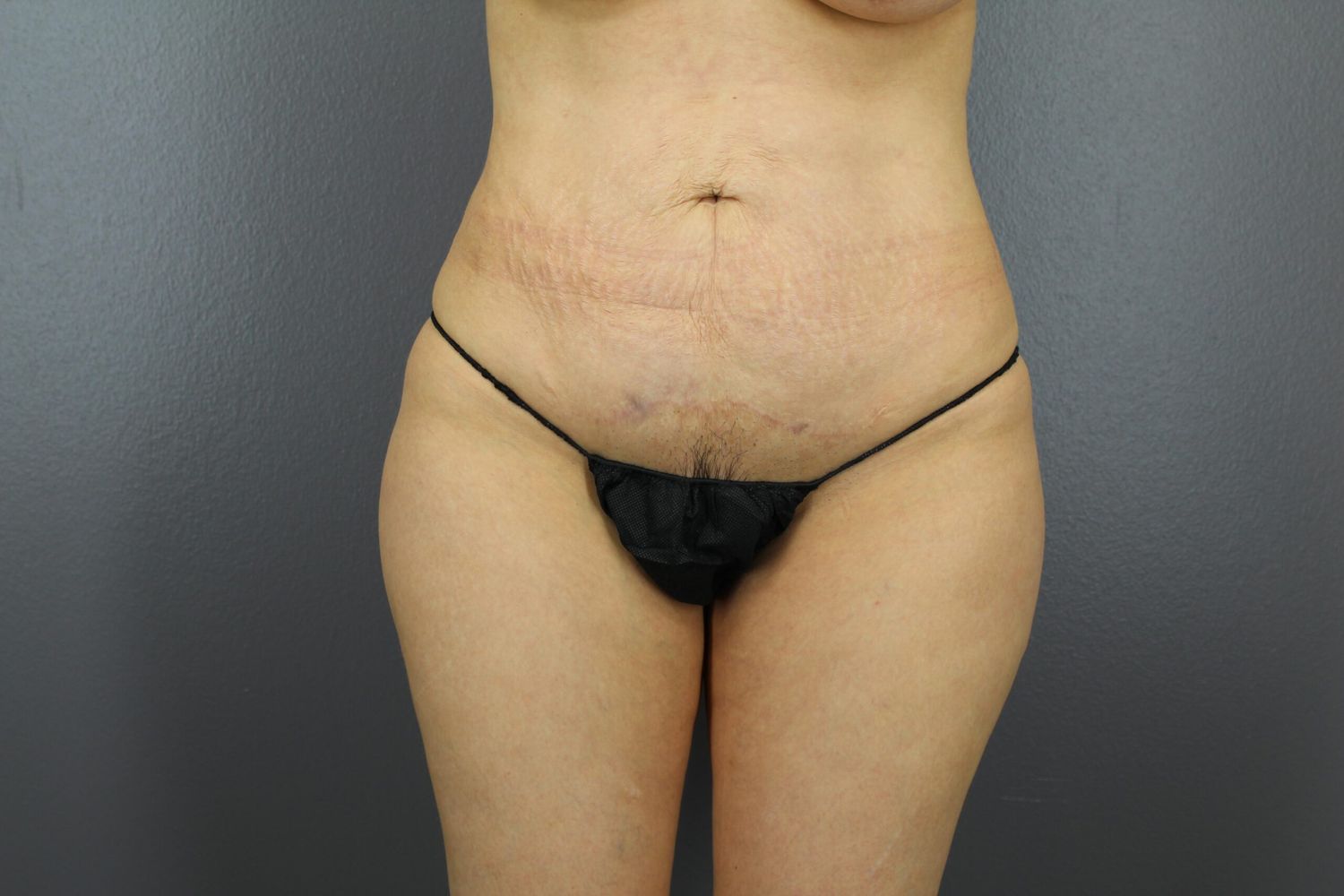 Body Contouring Before & After
