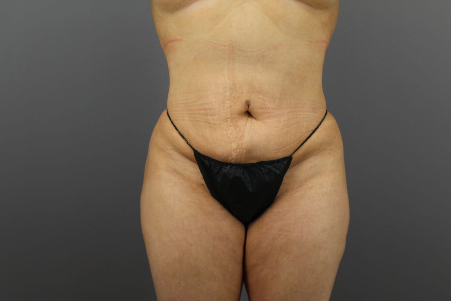 Body Contouring Before & After