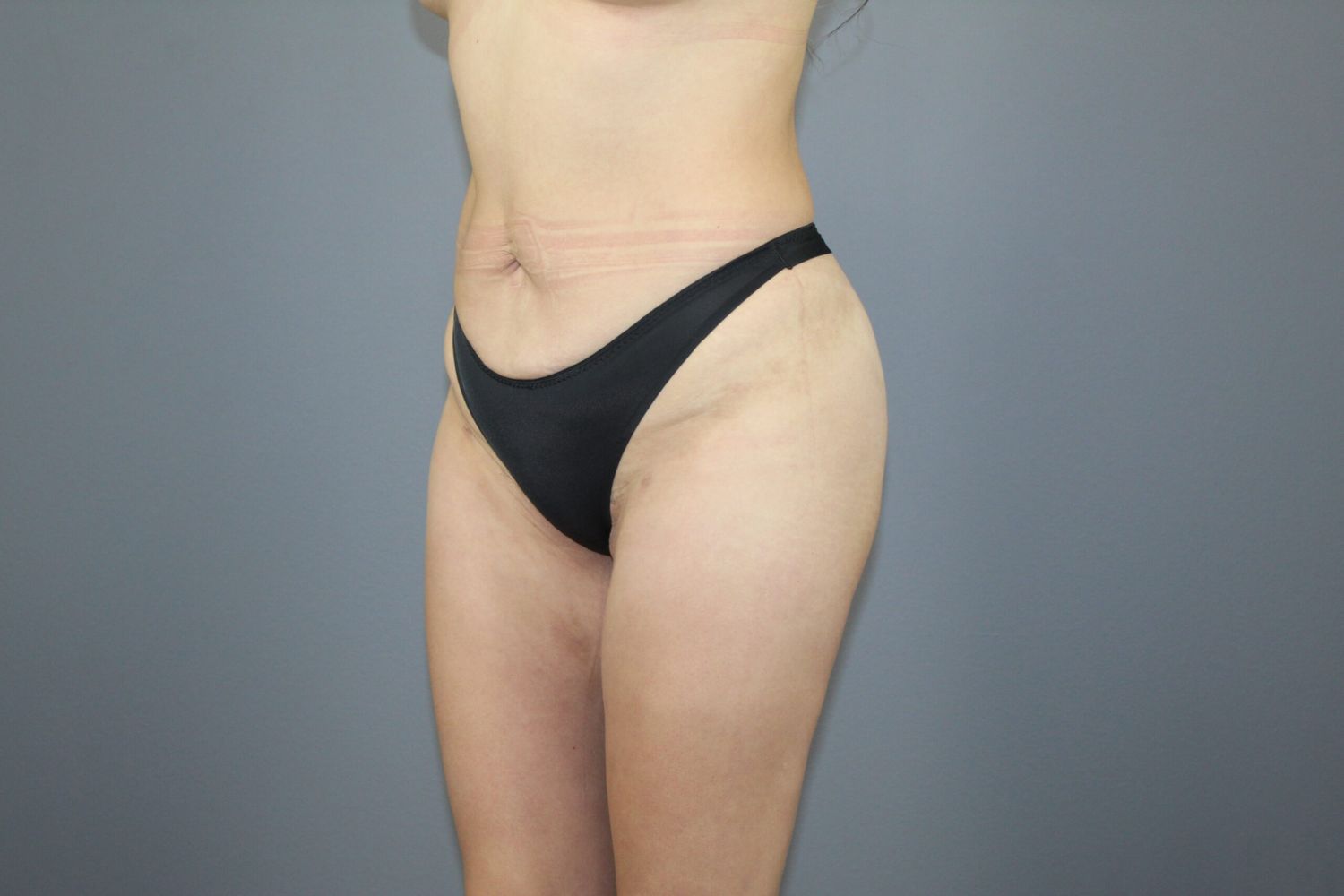 Body Contouring Before & After