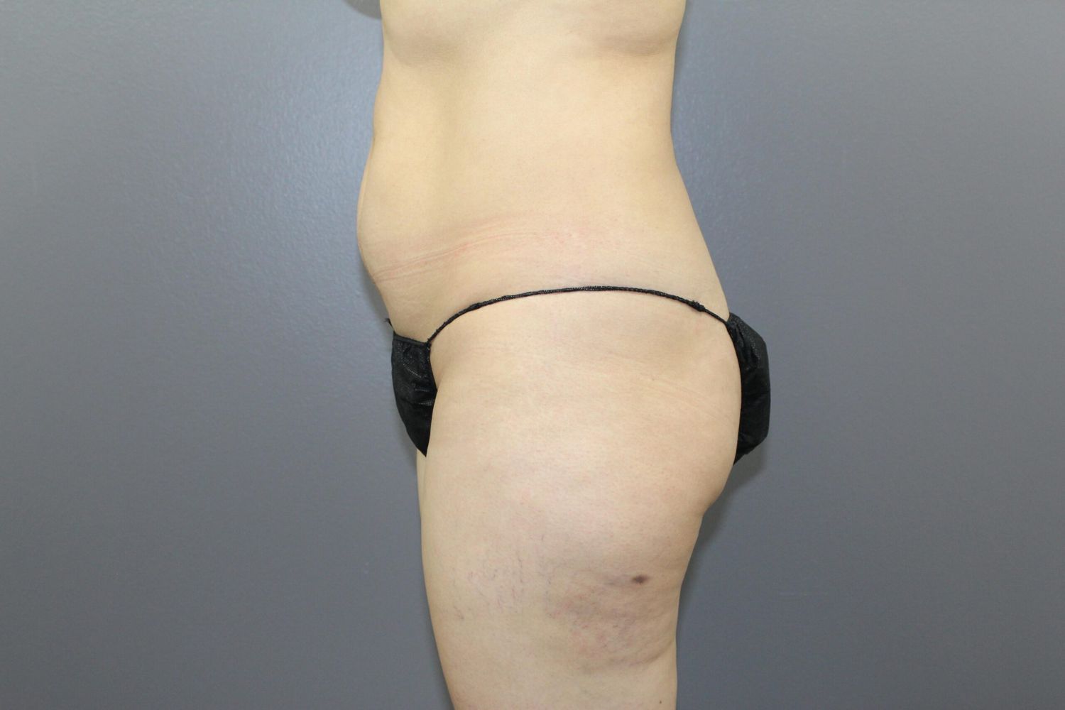 Body Contouring Before & After