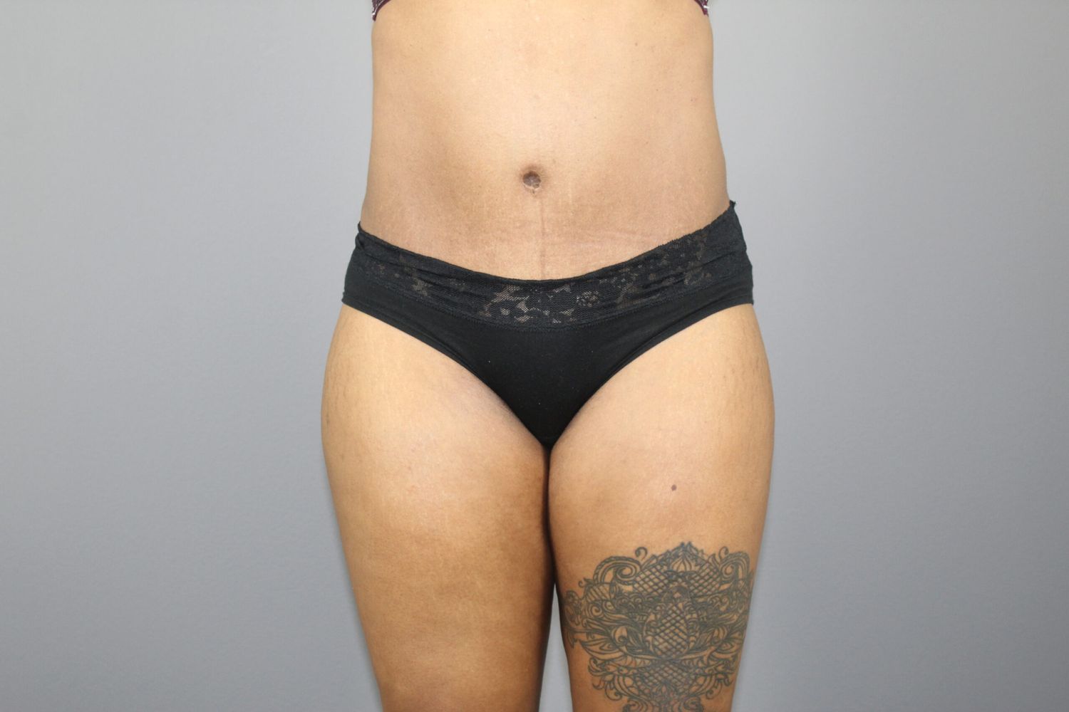 Body Contouring Before & After