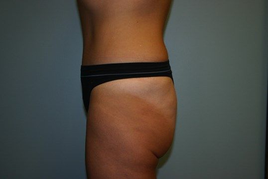 Body Contouring Before & After