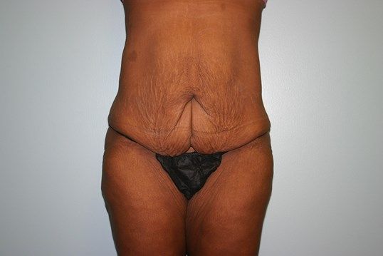 Body Contouring Before & After