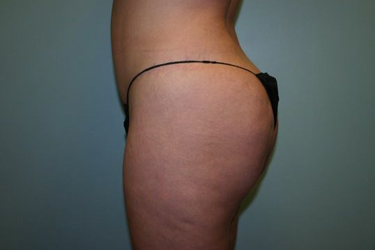 Body Contouring Before & After