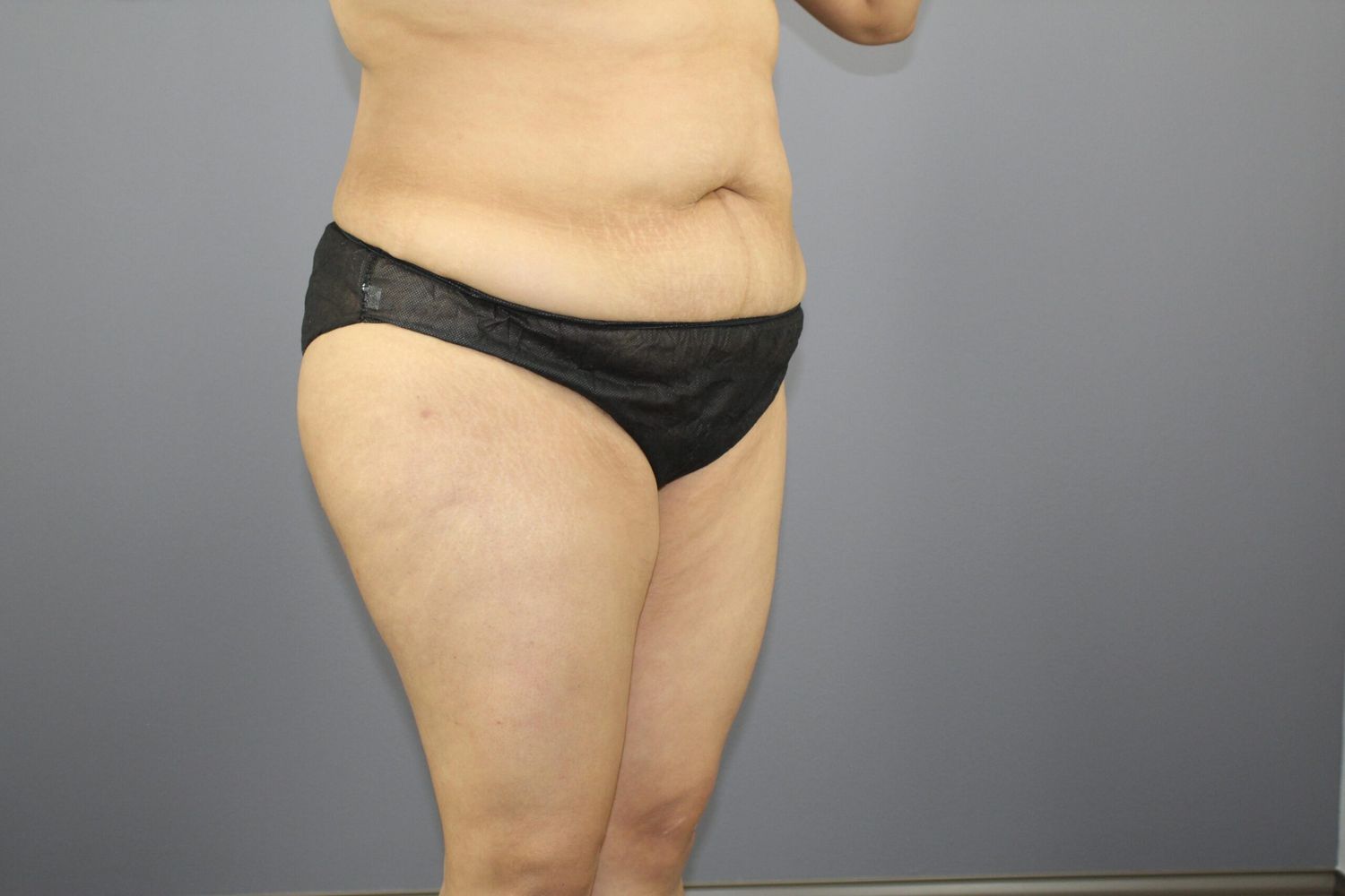 Body Contouring Before & After