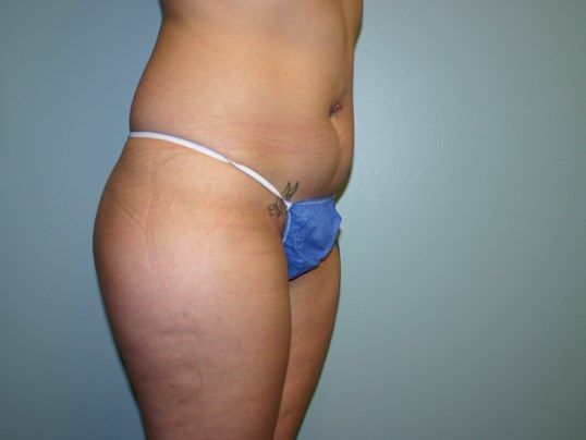 Body Contouring Before & After