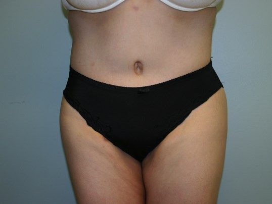 Body Contouring Before & After