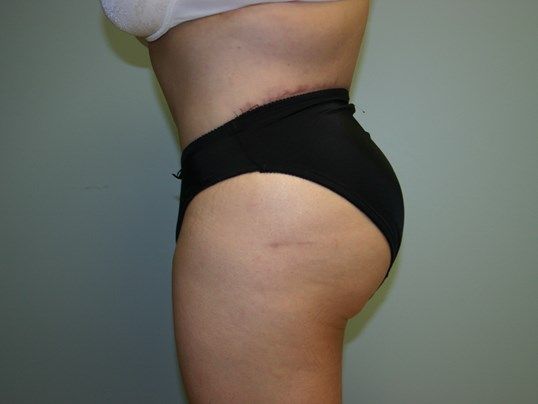 Body Contouring Before & After