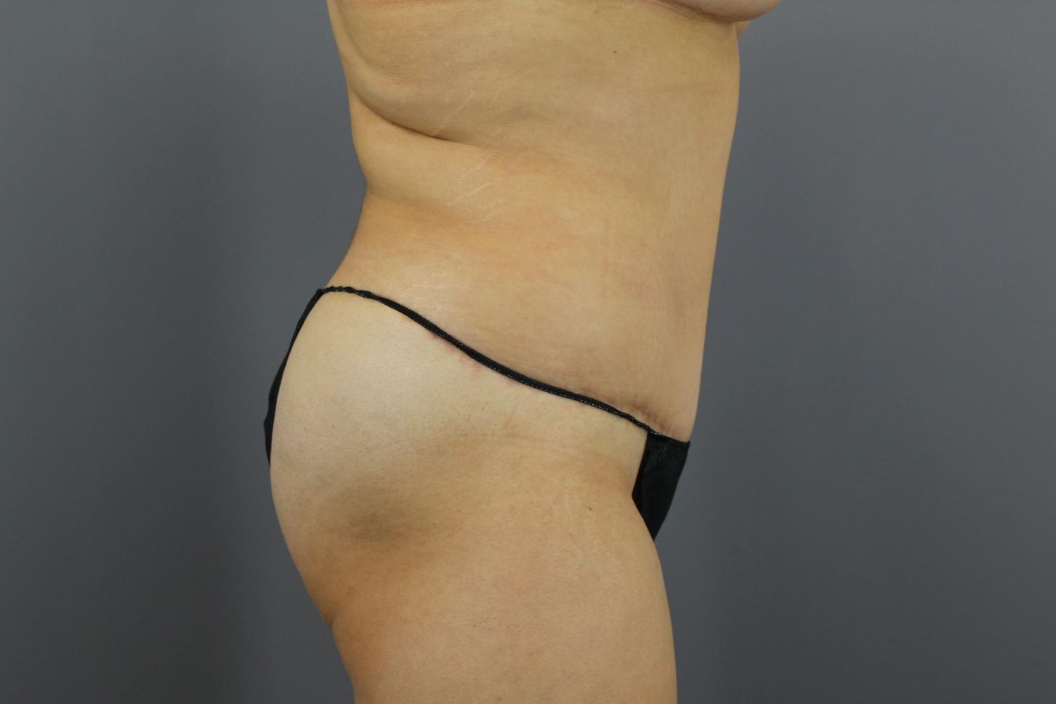Body Contouring Before & After