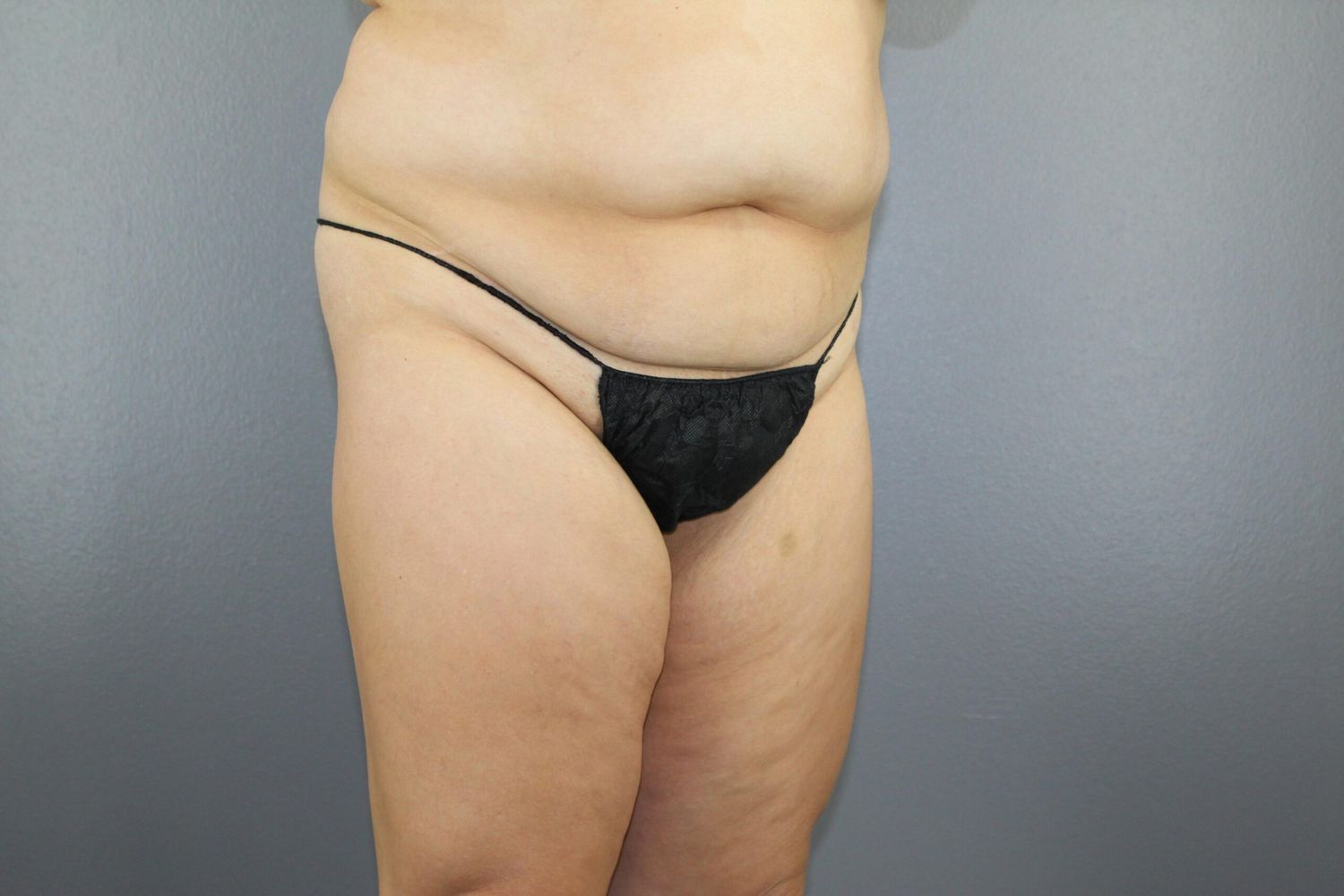 Body Contouring Before & After