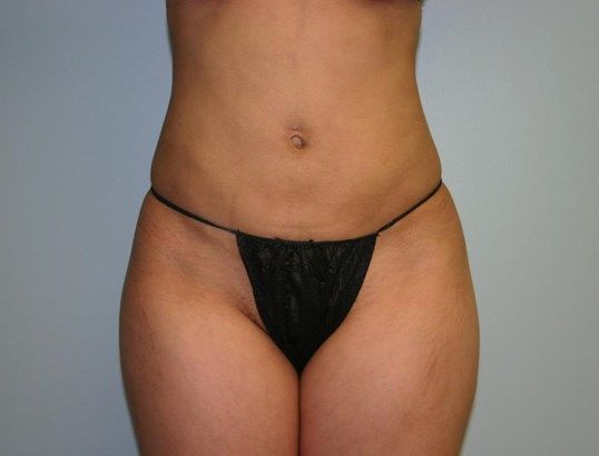Body Contouring Before & After
