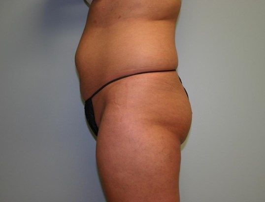 Body Contouring Before & After