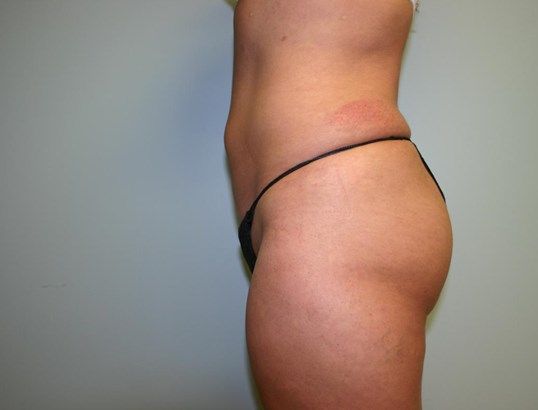Body Contouring Before & After