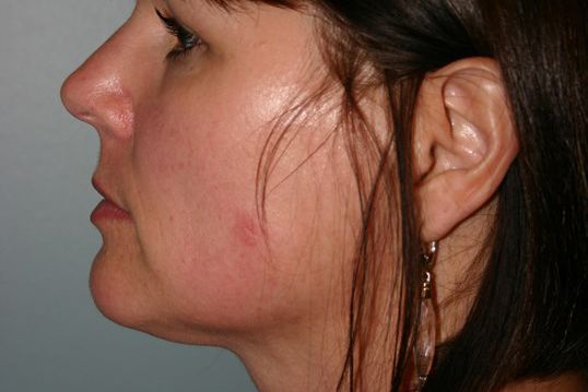 Body Contouring Before & After