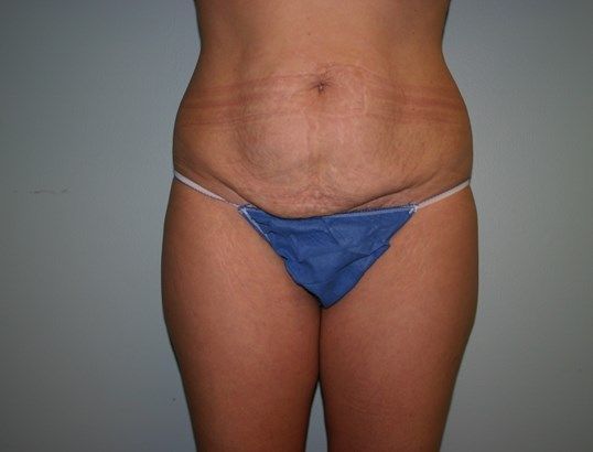 Body Contouring Before & After