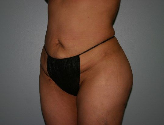 Body Contouring Before & After