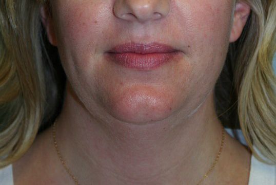 Body Contouring Before & After