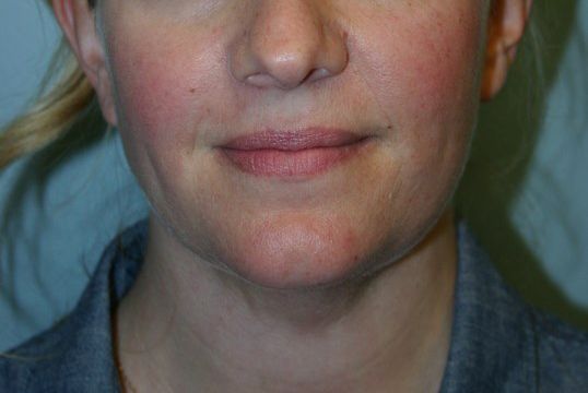 Body Contouring Before & After