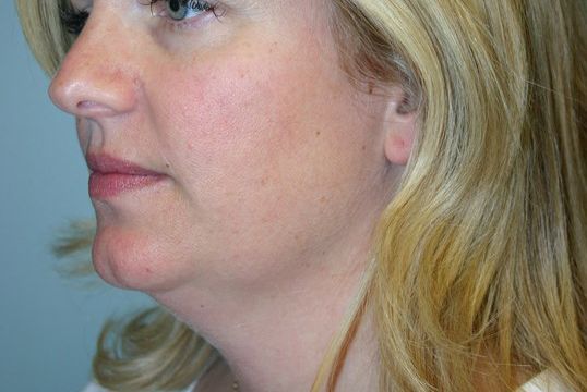 Body Contouring Before & After