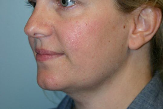 Body Contouring Before & After