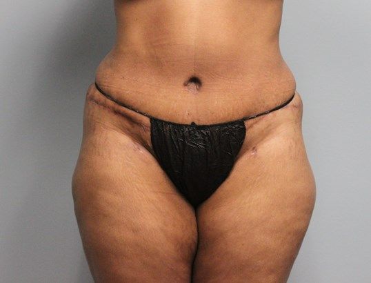 Body Contouring Before & After
