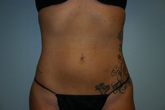 Body Contouring Before & After