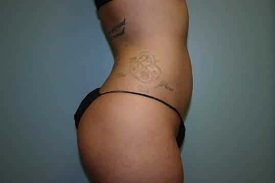 Body Contouring Before & After