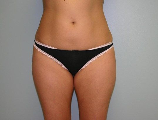 Body Contouring Before & After