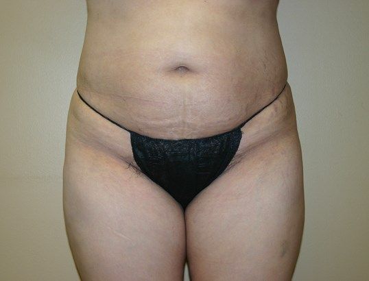 Body Contouring Before & After