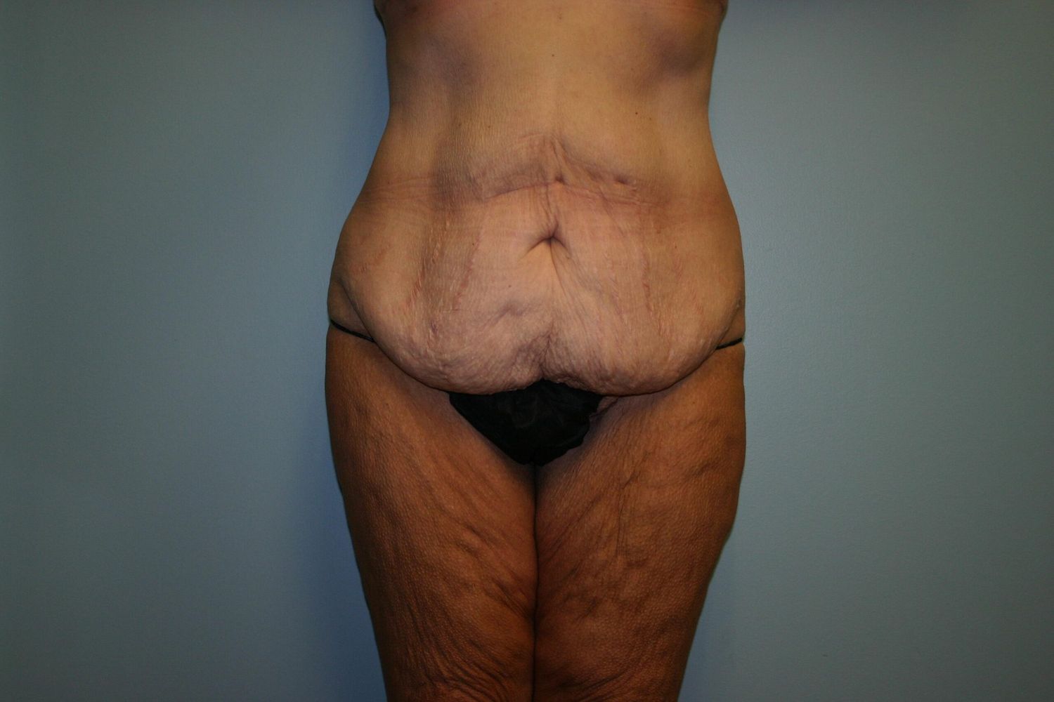 Body Contouring Before & After