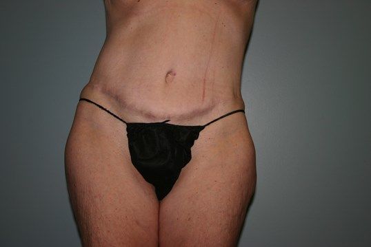 Body Contouring Before & After