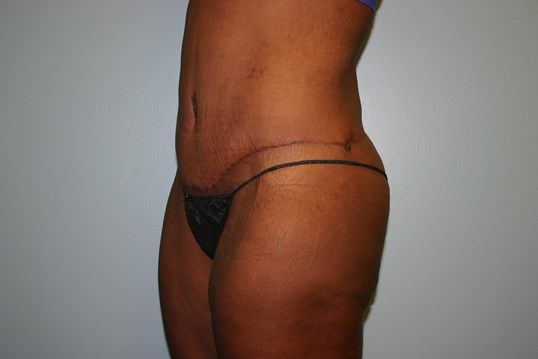 Body Contouring Before & After