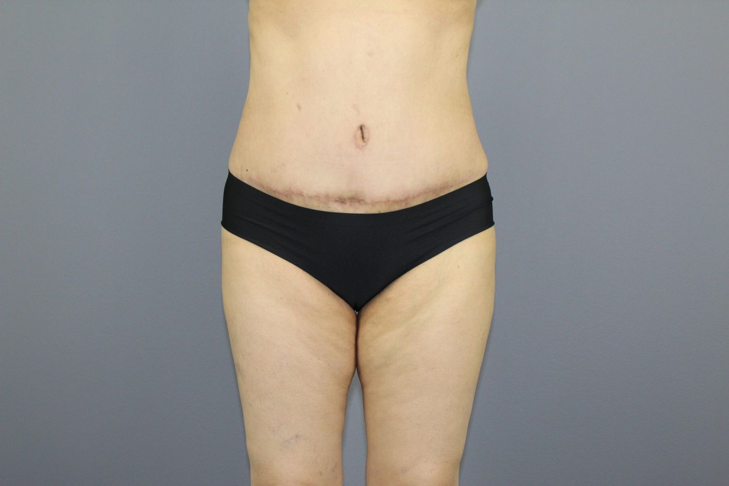 Body Contouring Before & After