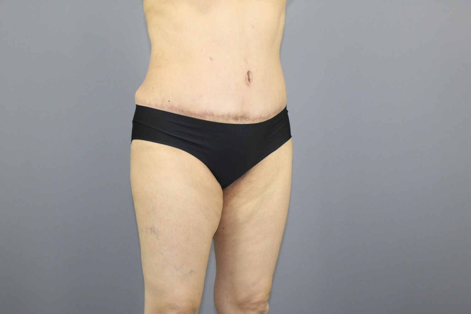 Body Contouring Before & After