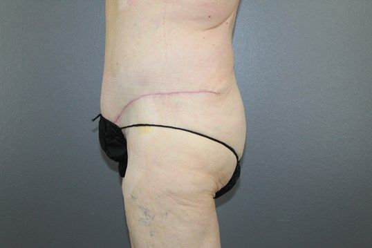 Body Contouring Before & After