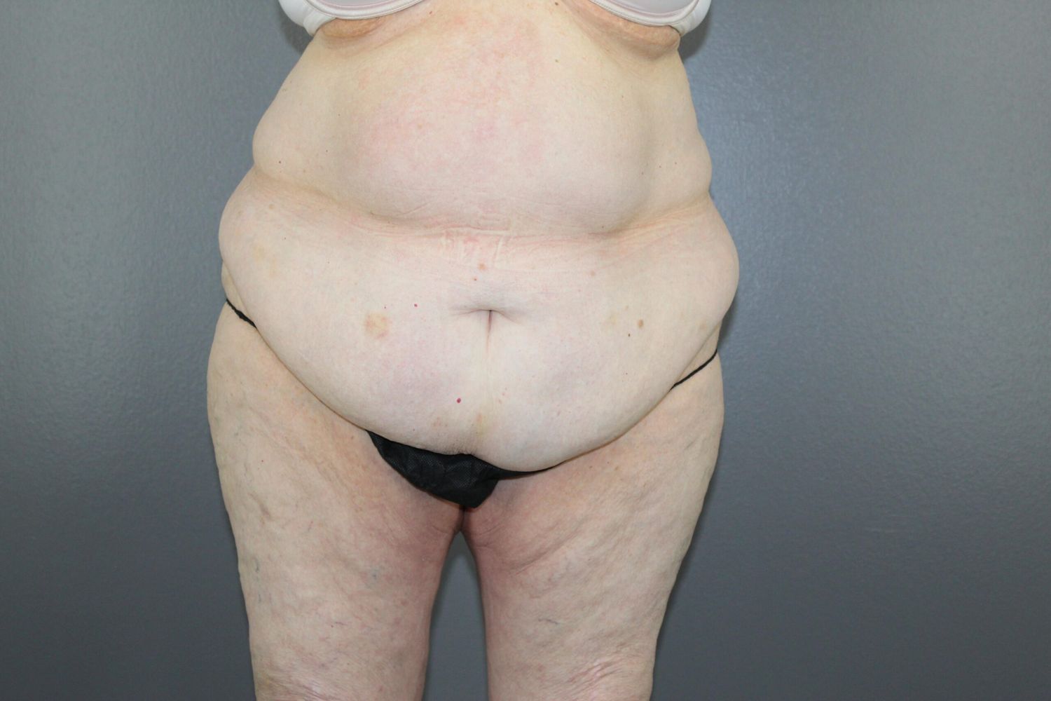 Body Contouring Before & After