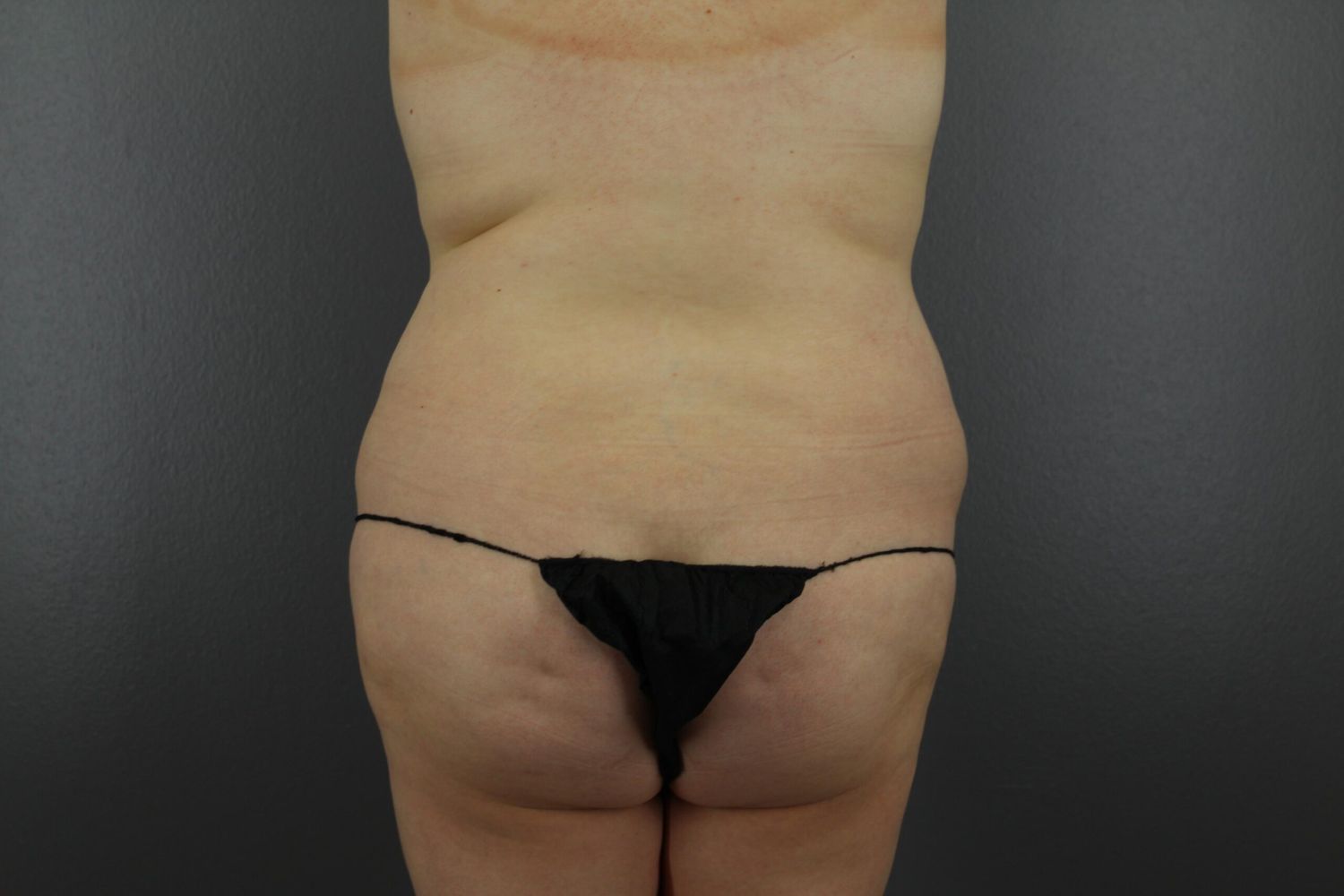 Body Contouring Before & After