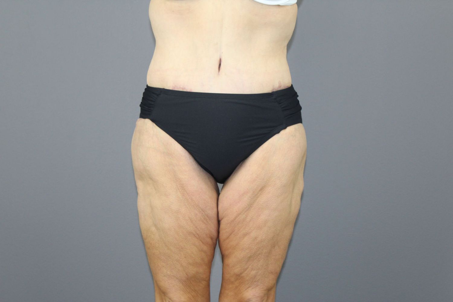 Body Contouring Before & After