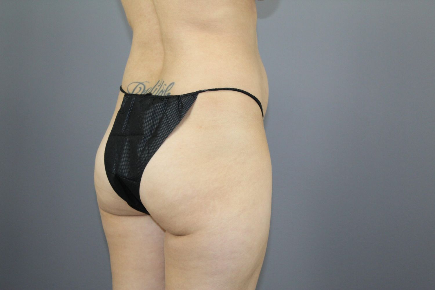 Body Contouring Before & After