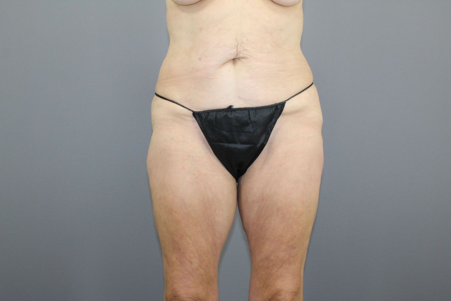 Body Contouring Before & After