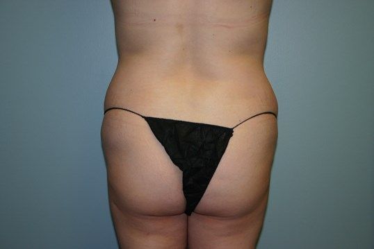 Body Contouring Before & After