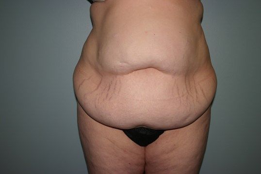 Body Contouring Before & After